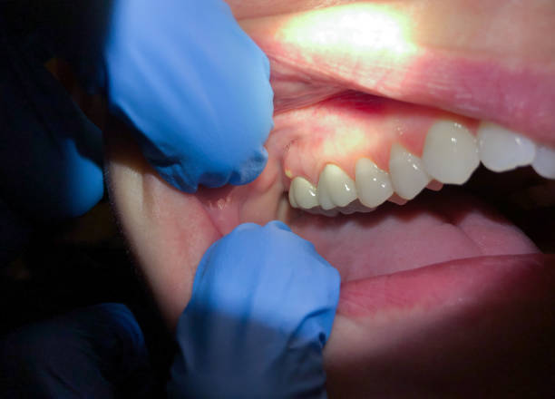 Best Emergency Dentist for Knocked-Out Tooth in Sellersburg, IN